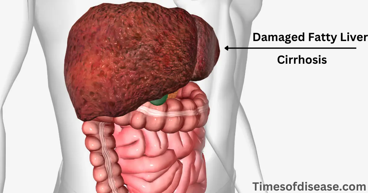 Fatty Liver ke Lakshan